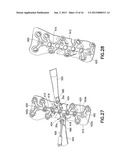 Method of Bending Bone Plate with Bending Tools diagram and image