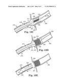 STENT POSITIONING SYSTEM AND METHOD diagram and image