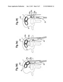 DEVICE FOR INSERTING AN INTERVERTEBRAL IMPLANT INTO A BODY AND SYSTEM     INCLUDING AN INTERVERTEBRAL IMPLANT AND A DEVICE FOR INSERTING SAME diagram and image