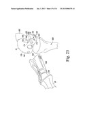 TRIALING SYSTEM FOR A KNEE PROSTHESIS AND METHOD OF USE diagram and image