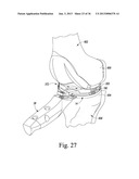 TRIALING SYSTEM FOR A KNEE PROSTHESIS AND METHOD OF USE diagram and image