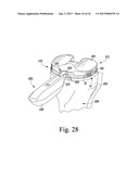 TRIALING SYSTEM FOR A KNEE PROSTHESIS AND METHOD OF USE diagram and image