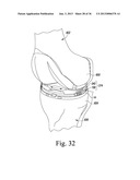 TRIALING SYSTEM FOR A KNEE PROSTHESIS AND METHOD OF USE diagram and image