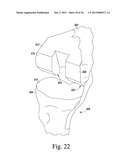 SYSTEM AND METHOD OF TRIALING A KNEE PROSTHESIS diagram and image