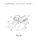 SYSTEM AND METHOD OF TRIALING A KNEE PROSTHESIS diagram and image