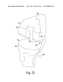 METHOD OF USING A TRIALING SYSTEM FOR A KNEE PROSTHESIS diagram and image