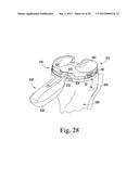 METHOD OF USING A TRIALING SYSTEM FOR A KNEE PROSTHESIS diagram and image