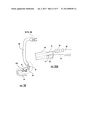 PYLORIC VALVE DEVICES AND METHODS diagram and image