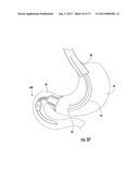 PYLORIC VALVE DEVICES AND METHODS diagram and image