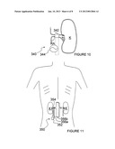 ULTRASOUND APPARATUSES FOR THERMALLY-INDUCED RENAL NEUROMODULATION AND     ASSOCIATED SYSTEMS AND METHODS diagram and image