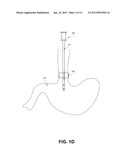 NASO/OROGASTRIC TUBE HAVING ONE OR MORE BACKFLOW BLOCKING ELEMENTS,     BACKFLOW BLOCKING ELEMENTS, AND A METHOD OF USING BACKFLOW BLOCKING     ELEMENTS diagram and image