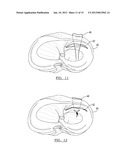 Method For Repairing A Meniscal Tear diagram and image
