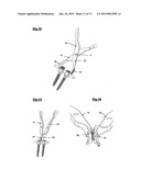 DEVICE AND METHOD FOR SPINAL SURGERY diagram and image