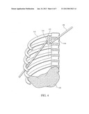 ELECTRICAL STIMULATION OF THE SYMPATHETIC NERVE CHAIN diagram and image