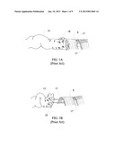 TENDON REPAIR DEVICE AND METHOD diagram and image