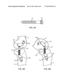 Transcutaneous Joint Unloading Device and Method diagram and image