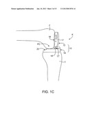 DYNAMIC KNEE BALANCER WITH PRESSURE SENSING diagram and image