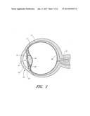 OCULAR IMPLANT WITH ANCHORING MECHANISM AND MULTIPLE OUTLETS diagram and image