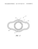 OCULAR IMPLANT WITH ANCHORING MECHANISM AND MULTIPLE OUTLETS diagram and image