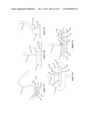 VACUUM COAGULATION PROBES diagram and image