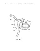 Multimodality Left Atrial Appendage Occlusion Device diagram and image