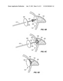 Multimodality Left Atrial Appendage Occlusion Device diagram and image