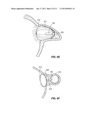 Multimodality Left Atrial Appendage Occlusion Device diagram and image