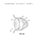 Multimodality Left Atrial Appendage Occlusion Device diagram and image