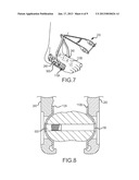 OSTEOTOMY AND ARTHRODESIS TREATMENT SYSTEMAANM Subik; MichaelAACI Atlantic HighlandsAAST NJAACO USAAGP Subik; Michael Atlantic Highlands NJ US diagram and image