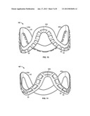 TECHNIQUES FOR ATTACHING FLEXIBLE LEAFLETS OF PROSTHETIC HEART VALVES TO     SUPPORTING STRUCTURESAANM Li; XueMeiAACI ShoreviewAAST MNAACO USAAGP Li; XueMei Shoreview MN USAANM Woo; Yi-RenAACI WoodburyAAST MNAACO USAAGP Woo; Yi-Ren Woodbury MN US diagram and image