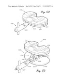 DISTRACTOR HAVING A CAPACITIVE SENSOR ARRAY FOR MEASURING A FORCE,     PRESSURE, OR LOAD APPLIED BY THE MUSCULAR-SKELETAL SYSTEM AND METHOD     THEREFOR diagram and image