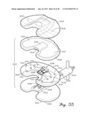 DISTRACTOR HAVING A CAPACITIVE SENSOR ARRAY FOR MEASURING A FORCE,     PRESSURE, OR LOAD APPLIED BY THE MUSCULAR-SKELETAL SYSTEM AND METHOD     THEREFOR diagram and image