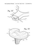 DISTRACTOR HAVING AN INTERNAL LOAD MEASURMENT SYSTEM FOR THE     MUSCULAR-SKELETAL SYSTEM AND METHOD THEREFOR diagram and image