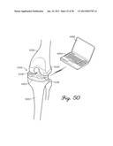 DISTRACTOR HAVING AN INTERNAL LOAD MEASURMENT SYSTEM FOR THE     MUSCULAR-SKELETAL SYSTEM AND METHOD THEREFOR diagram and image