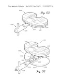 DISTRACTOR HAVING AN INTERNAL LOAD MEASURMENT SYSTEM FOR THE     MUSCULAR-SKELETAL SYSTEM AND METHOD THEREFOR diagram and image