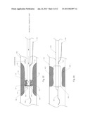 Devices and Methods for Endovascular Therapies diagram and image