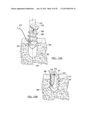 Method for Tissue Fixation diagram and image