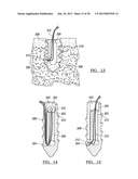 Method for Tissue Fixation diagram and image