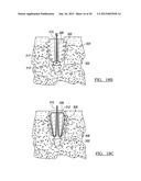 Method for Tissue Fixation diagram and image