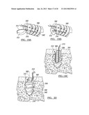 Method for Tissue Fixation diagram and image