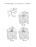 Method for Tissue Fixation diagram and image