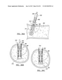 Method for Tissue Fixation diagram and image