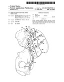 BONE FIXATION WITH OVERLAPPING BONE PLATES diagram and image