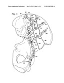 BONE FIXATION WITH OVERLAPPING BONE PLATES diagram and image