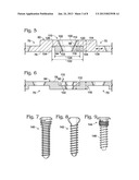 BONE FIXATION WITH OVERLAPPING BONE PLATES diagram and image