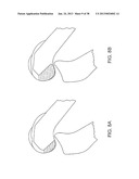 SYSTEMS AND METHODS FOR PROVIDING DEEPER KNEE FLEXION CAPABILITIES FOR     KNEE PROSTHESIS PATIENTS diagram and image