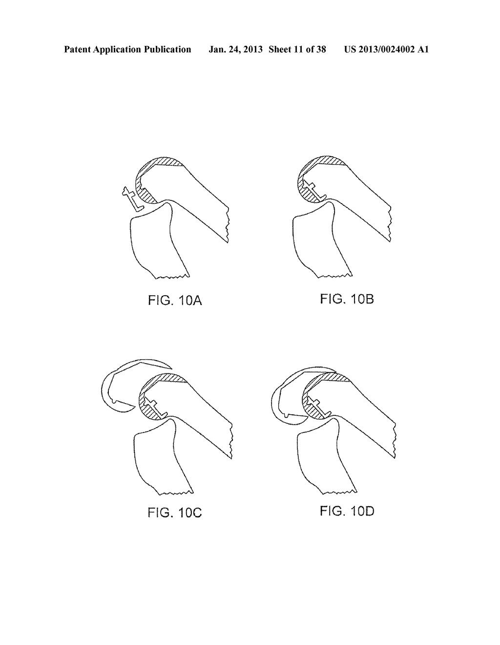 SYSTEMS AND METHODS FOR PROVIDING DEEPER KNEE FLEXION CAPABILITIES FOR     KNEE PROSTHESIS PATIENTS - diagram, schematic, and image 12