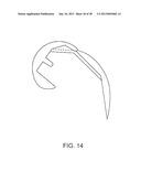 SYSTEMS AND METHODS FOR PROVIDING DEEPER KNEE FLEXION CAPABILITIES FOR     KNEE PROSTHESIS PATIENTS diagram and image