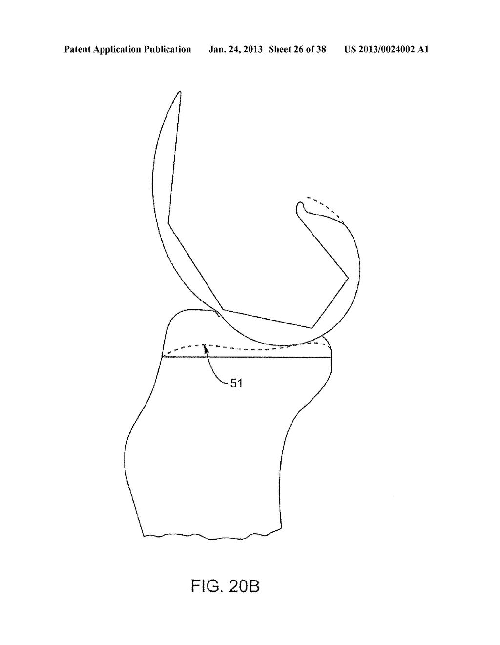 SYSTEMS AND METHODS FOR PROVIDING DEEPER KNEE FLEXION CAPABILITIES FOR     KNEE PROSTHESIS PATIENTS - diagram, schematic, and image 27