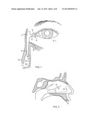 Side-by-side lacrimal intubation threader device diagram and image